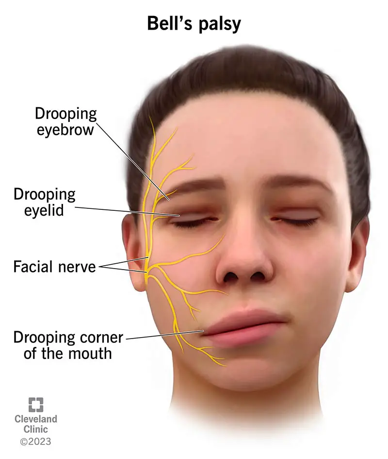 5457 bells palsy