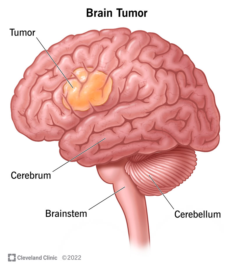 6149 brain tumor