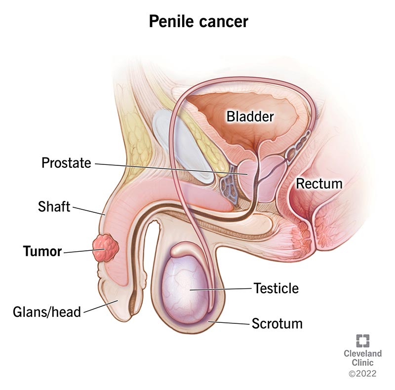 6181 penile cancer