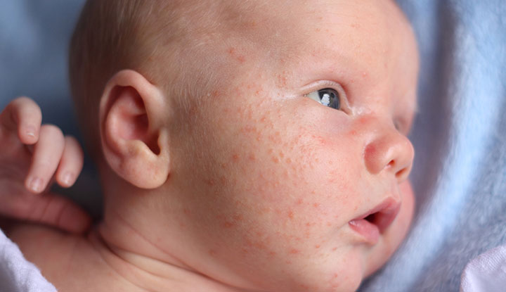 L'acne infantile provoca la comparsa di piccole protuberanze bianche e brufoli rosa sul viso del tuo bambino.