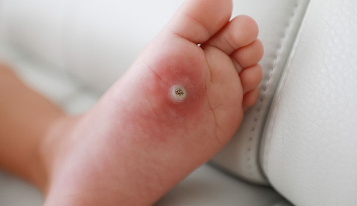 Le verruche sui bambini sono un tipo di infezione della pelle causata dall'HPV.  L'infezione provoca la formazione di protuberanze dure sulla pelle del bambino.