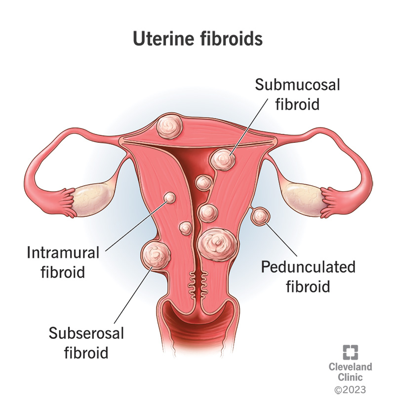 9130 uterine fibroids