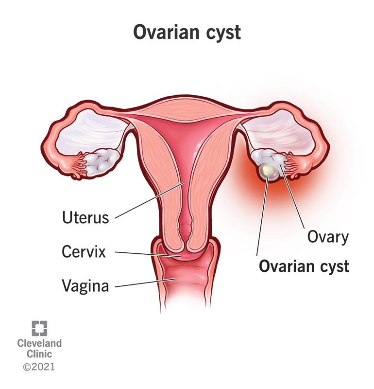 9133 ovarian cysts