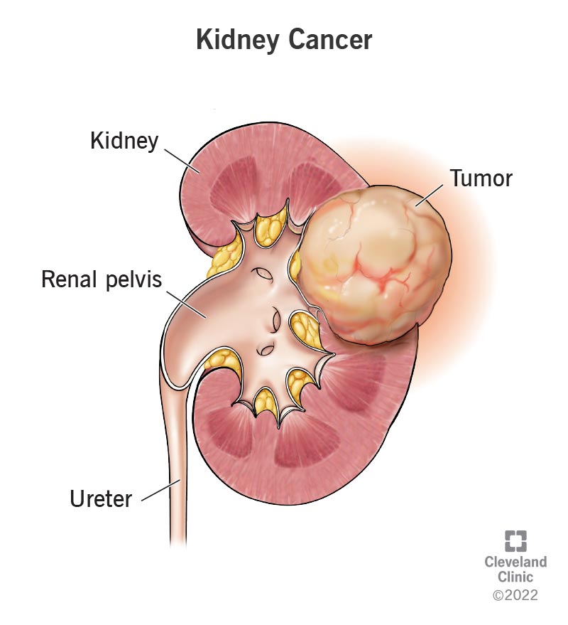 9409 kidney cancer