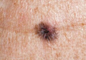 Melanoma 155131938770x533 1 jpg