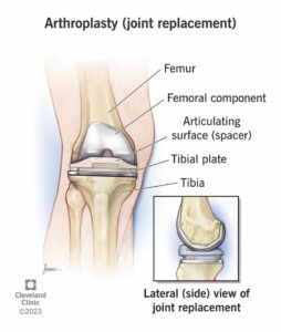 arthroplasty