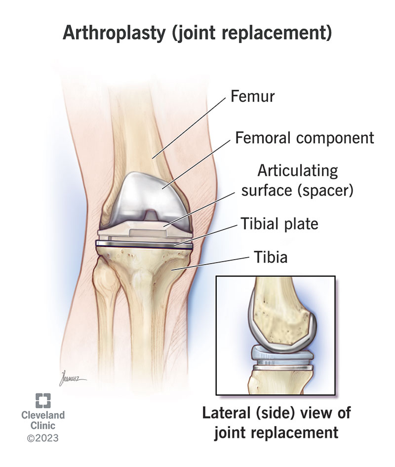 arthroplasty