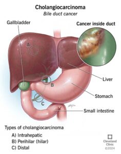 bile duct cancer cholangiocarcinoma