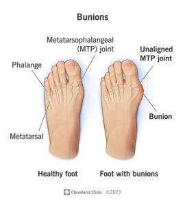 bunions