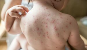 chickenpox