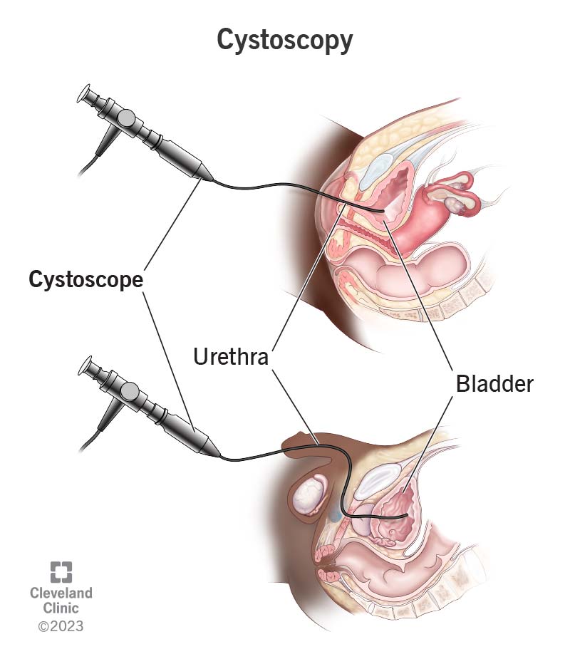 cystoscopy