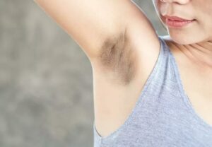 dark armpit 1181829080 770x533 1 jpg