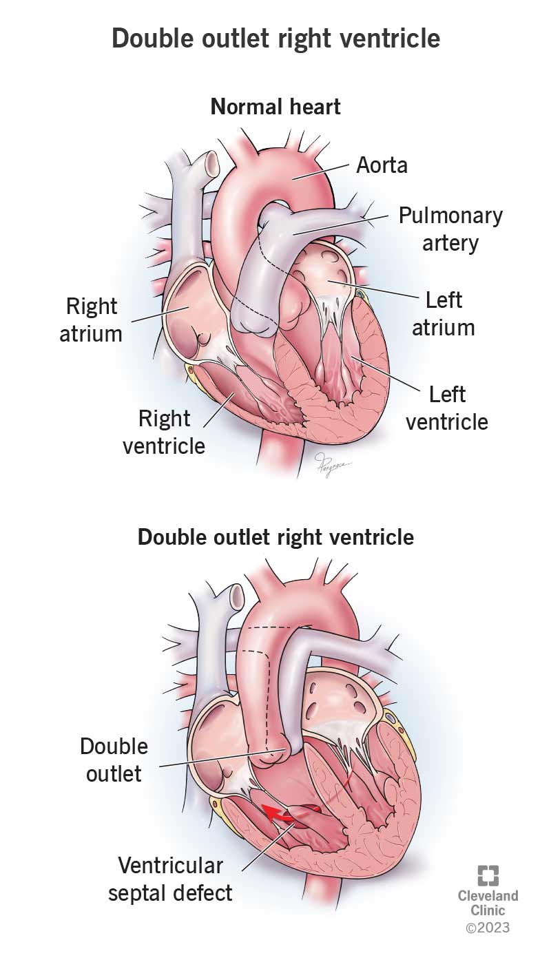 Due arterie principali, invece di una, si collegano al ventricolo destro nel ventricolo destro a doppia uscita.