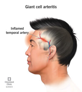 giant cell arteritis