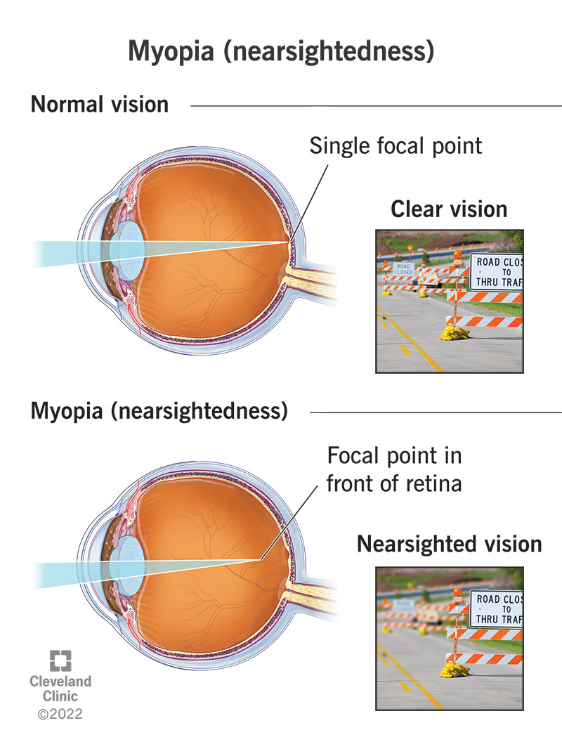 Un segnale stradale sfocato con miopia (miope) rispetto a un segnale stradale chiaro con una visione normale.