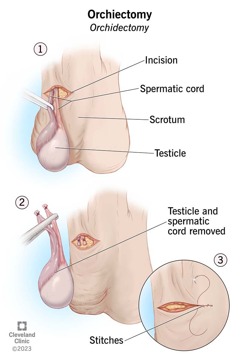 Testicoli che mostrano dove vengono praticate le incisioni durante l'ochiectomia.