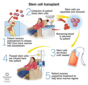 stem cell transplant