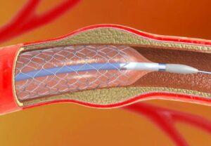 stentAngioplasty 1136631791 770x553 1 jpg