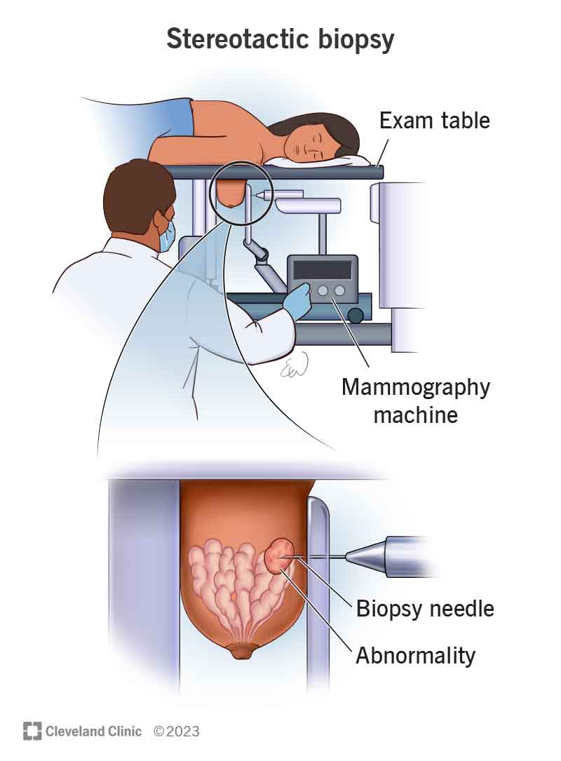 Una persona sdraiata su un tavolo durante una biopsia stereotassica e un primo piano dell'ago da biopsia che rimuove il tessuto dal tumore.
