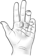 Dito a scatto, quando le dita o il pollice restano in posizione flessa nella mano sinistra di una persona.