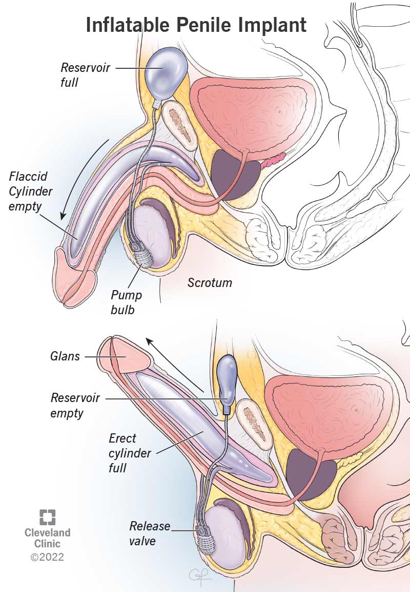 Le protesi peniene gonfiabili utilizzano una pompa per inviare il fluido da un serbatoio ai cilindri del pene per ottenere un'erezione.