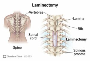 10895 laminectomy