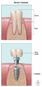 10903 dental implants