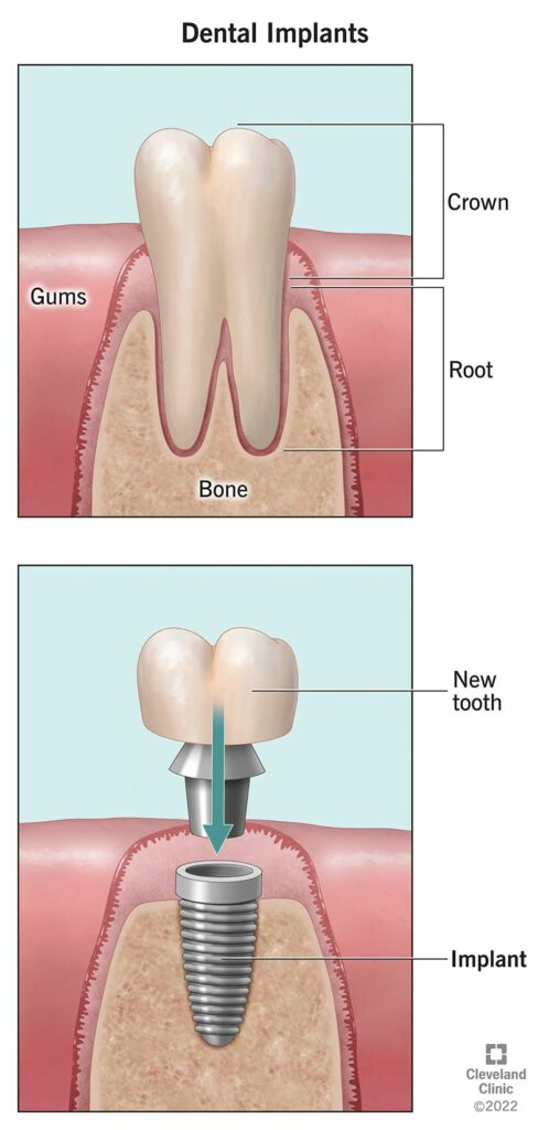 10903 dental implants