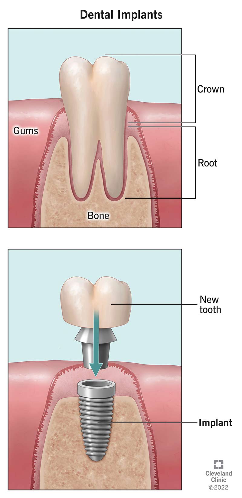 Dente naturale vs. impianto dentale nell'osso mascellare.