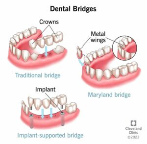 10921 dental bridge