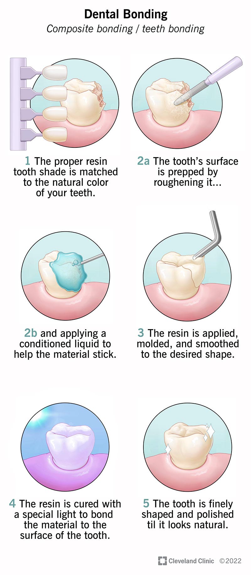 spiegazione passo passo della procedura di bonding dentale