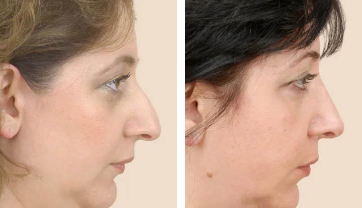 11011 rhinoplasty