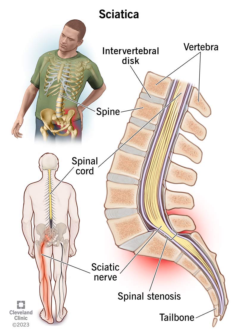I sintomi della sciatica possono colpire la parte bassa della schiena, i glutei e le gambe.  La causa è spesso la pressione sul midollo spinale o sui nervi.