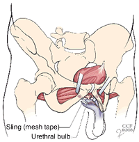 Procedura di sling maschile
