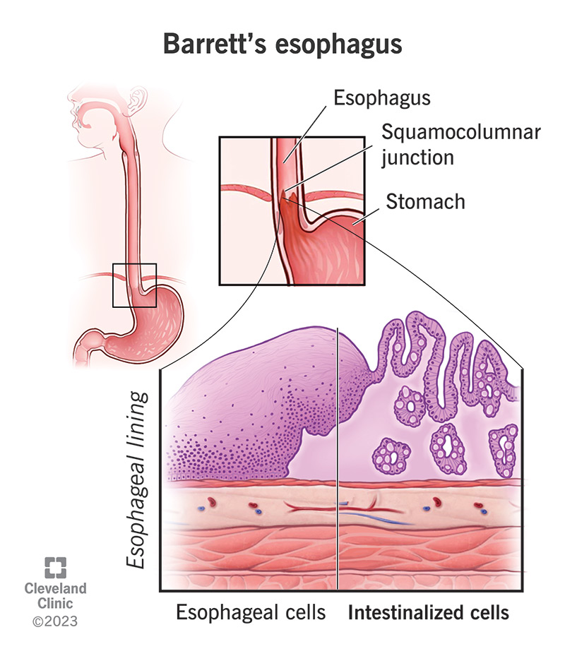 14432 barretts esophagus