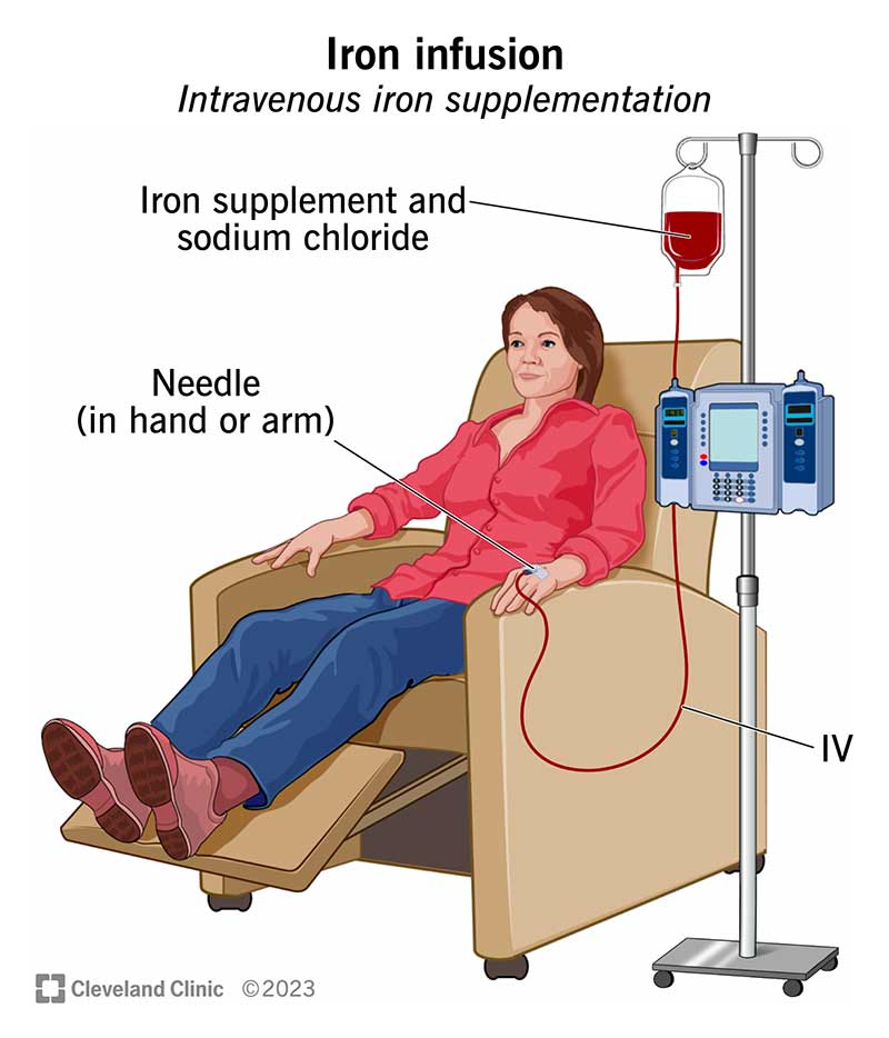 14571 iron infusion illustration