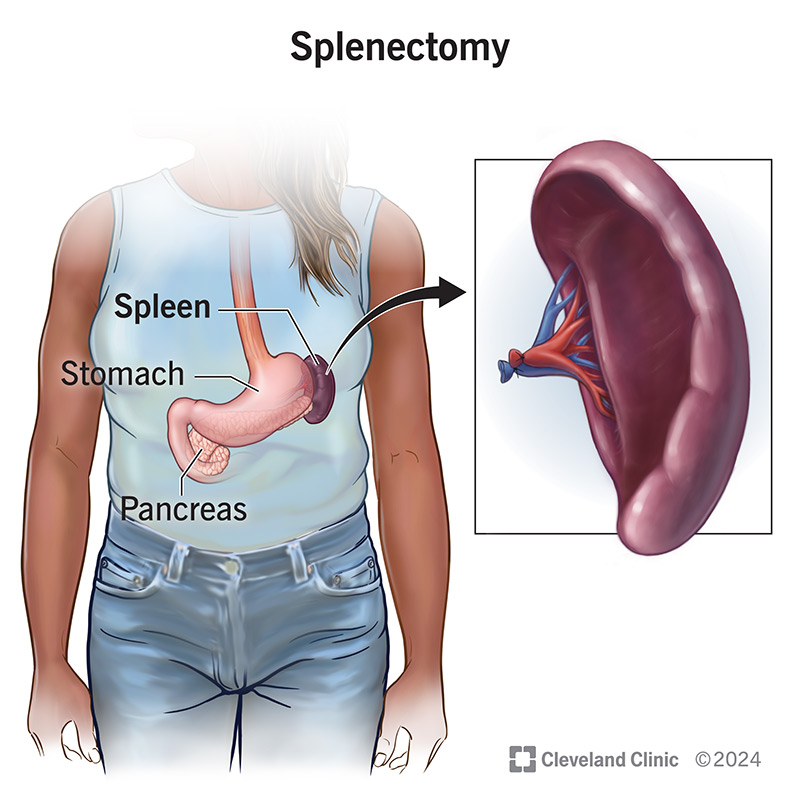 14614 splenectomy