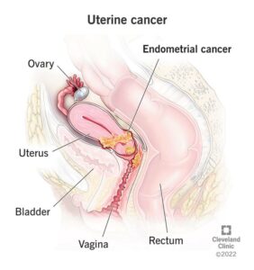 16409 uterine endometrial cancer
