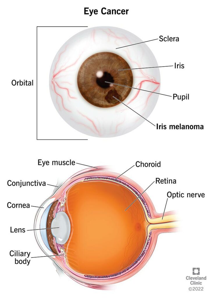 17292 eye cancer