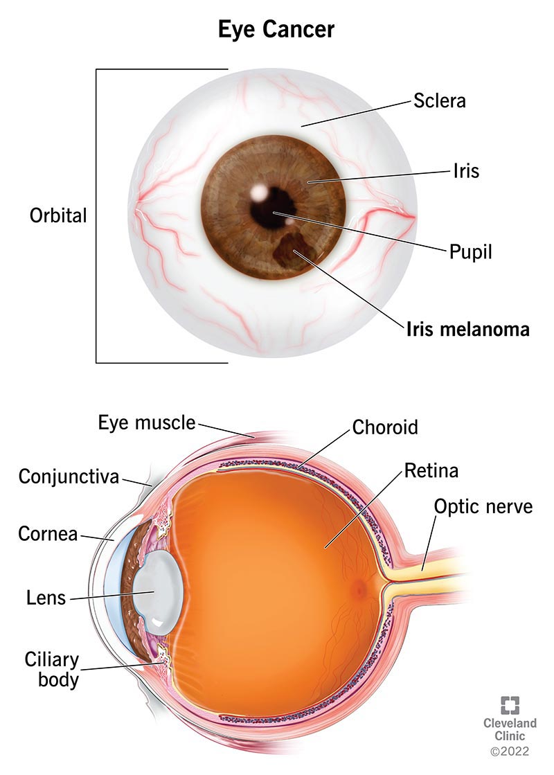 Viste frontali e laterali dell'anatomia di un bulbo oculare con melanoma dell'iride.