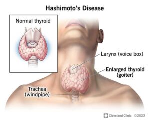 17665 hashimotos disease