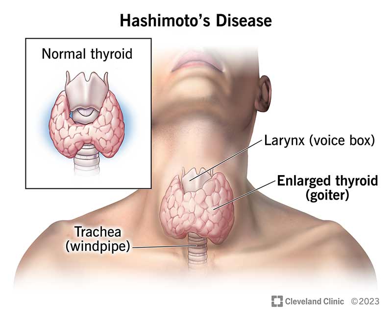 17665 hashimotos disease