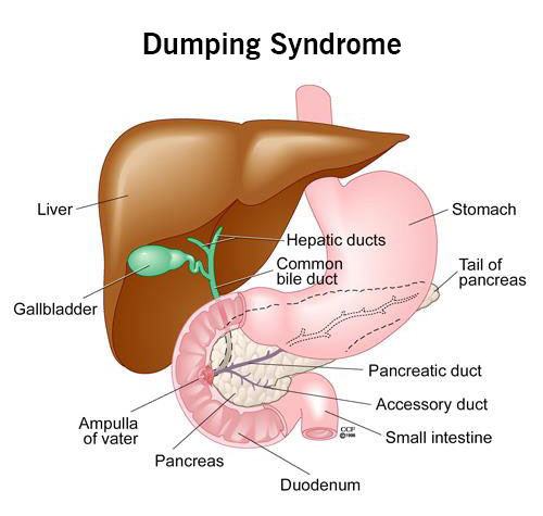 17835 dumping syndrome