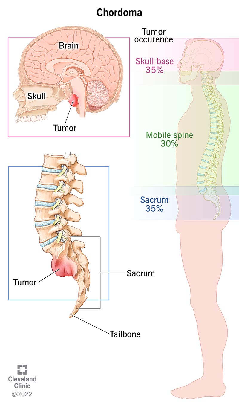 Il tasso di insorgenza di tumori alla base del cranio, alla colonna vertebrale e all'osso sacro è rispettivamente del 35%, 30% e 35%.