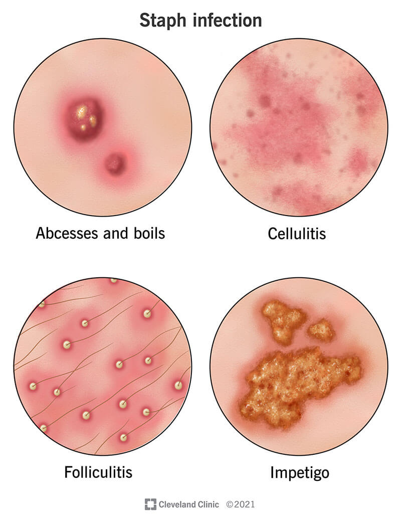 Un'infezione da stafilococco sulla pelle può presentarsi come piccoli noduli pieni di pus con follicolite, noduli più grandi con ascessi e foruncoli e croste irregolari con impetigine, mentre la cellulite all'interno della pelle si manifesta come chiazze infiammate.
