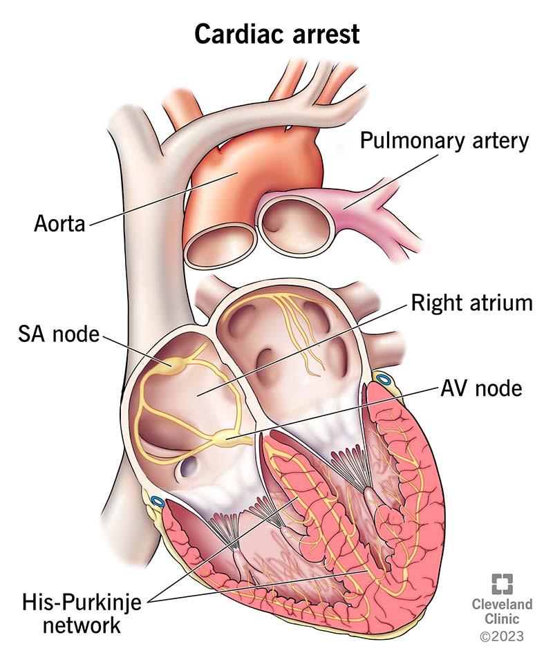 L'arresto cardiaco si verifica a causa di un problema con il sistema elettrico del cuore.