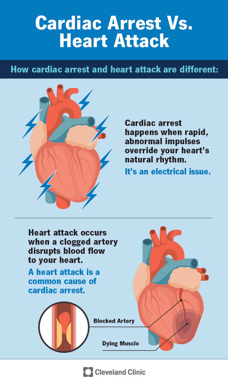 Segnali anomali provocano l'arresto cardiaco, ma un'ostruzione nell'arteria provoca un infarto.