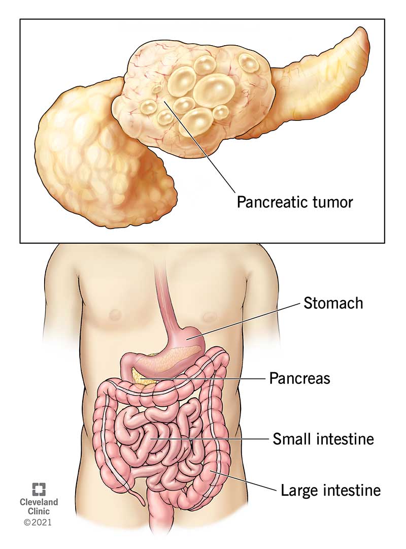 Il pancreas nell'addome, insieme a un tumore al pancreas.