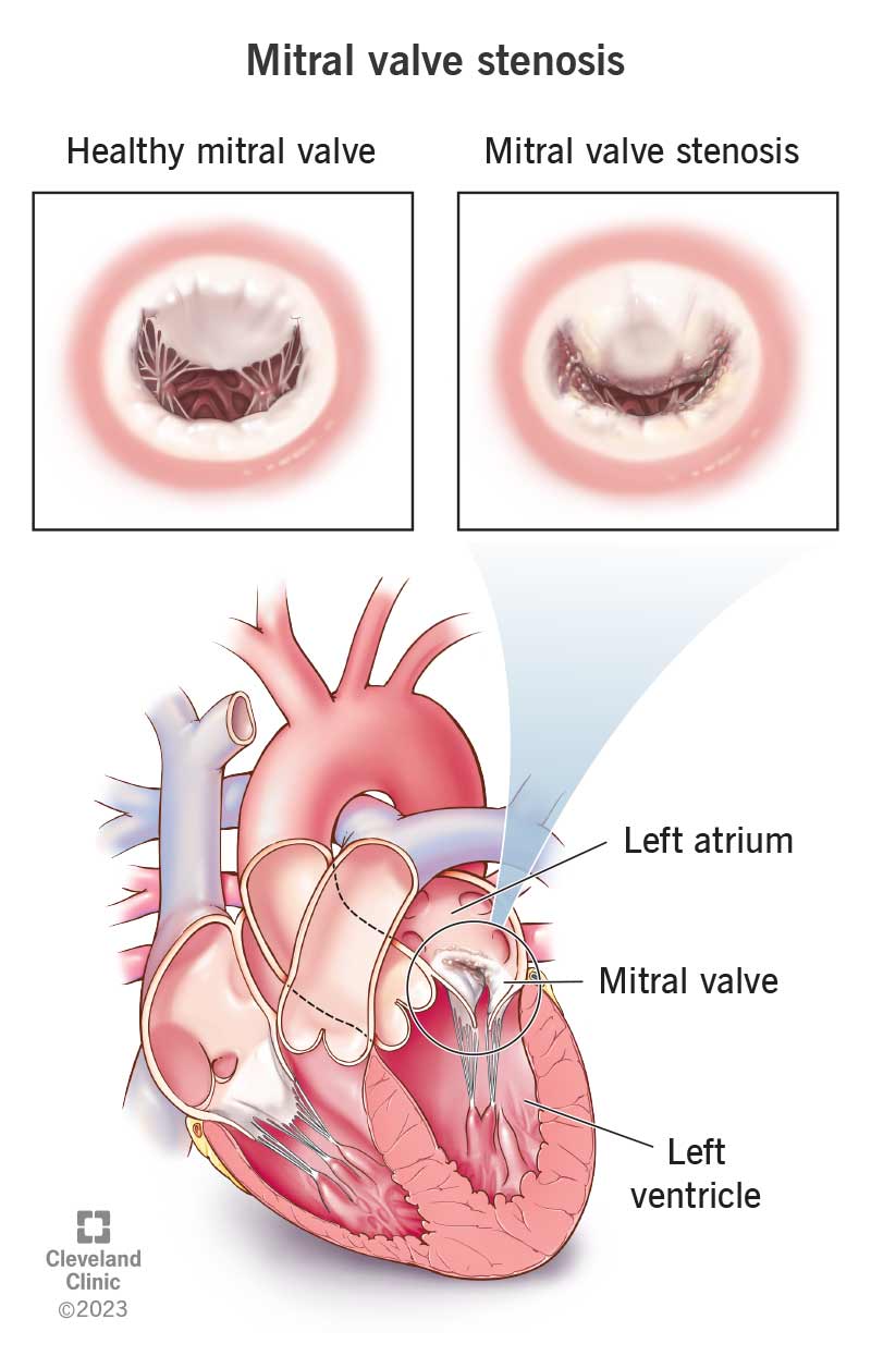 La stenosi della valvola mitrale è un'apertura stretta che consente al sangue di fluire tra le camere sinistre del cuore.