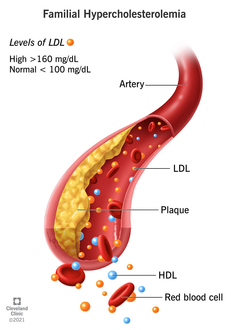 Illustrazione dell'accumulo di placche nelle arterie dovuto a ipercolesterolemia familiare.